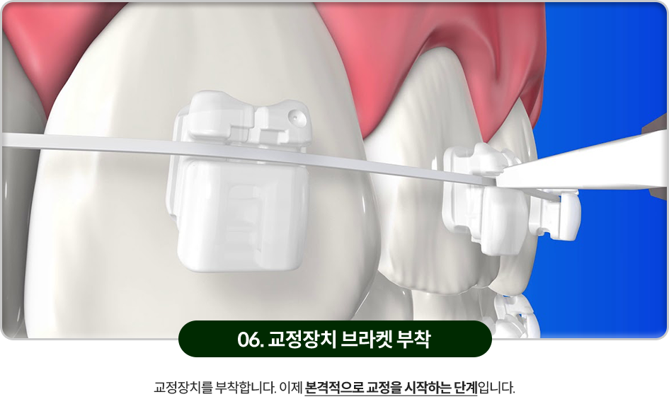 06)-교정장치-브라켓-부착-교정장치를-부착합니다-이제-본격적으로-교정을-시작하는-단계입니다