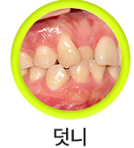 덧니-선택됨