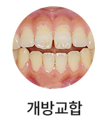 개방교합