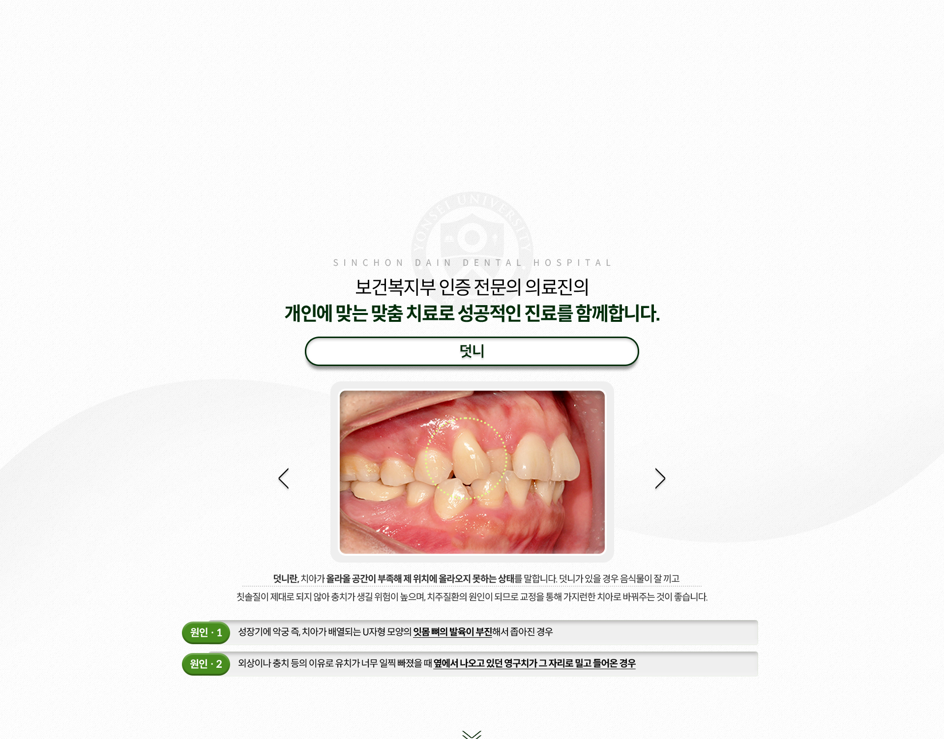 덧니-치아가-올라올-공간이-부족해-제-위치에-올라오지-못하는-상태-음식물이-잘-끼고-칫솔질이-제대로-되지-않아-충치가-생길-위험이-높으며,-치주질환의-원인이-됨-원인1-성장기에-치아가-배열되는-U자형-모양의-잇몸-뼈의-발육이-부진해서-좁아진-경우-원인2-외상이나-충치-등의-이유로-유치가-너무-일찍-빠졌을-때-옆에서-나오고-있던-영구치가-그-자리로-밀고-들어온-경우