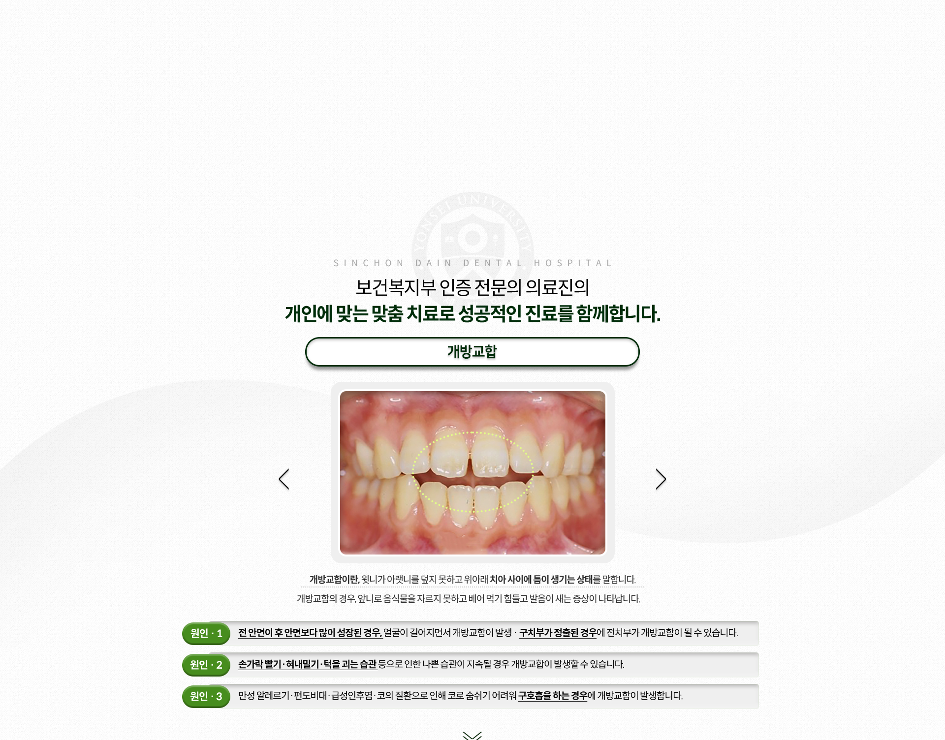 개방교합-윗니가-아랫니를-덮지-못하고-위아래-치아-사이에-틈이-생기는-상태-앞니로-음식물을-자르지-못하고-베어-먹기-힘들고-발음이-새는-증상-원인1-전-안면이-후-안면보다-많이-성장된-경우,-얼굴이-길어지면서-개방교합이-발생,-구치부가-정출된-경우에-전치부가-개방교합이-될-수-있음-원인2-손가락-빨기,-혀내밀기,-턱을-괴는-습관-원인3-만성-알레르기,-편도비대,-급성인후염,-코의-질환으로-인해-코로-숨쉬기-어려워-구호흡을-하는-경우