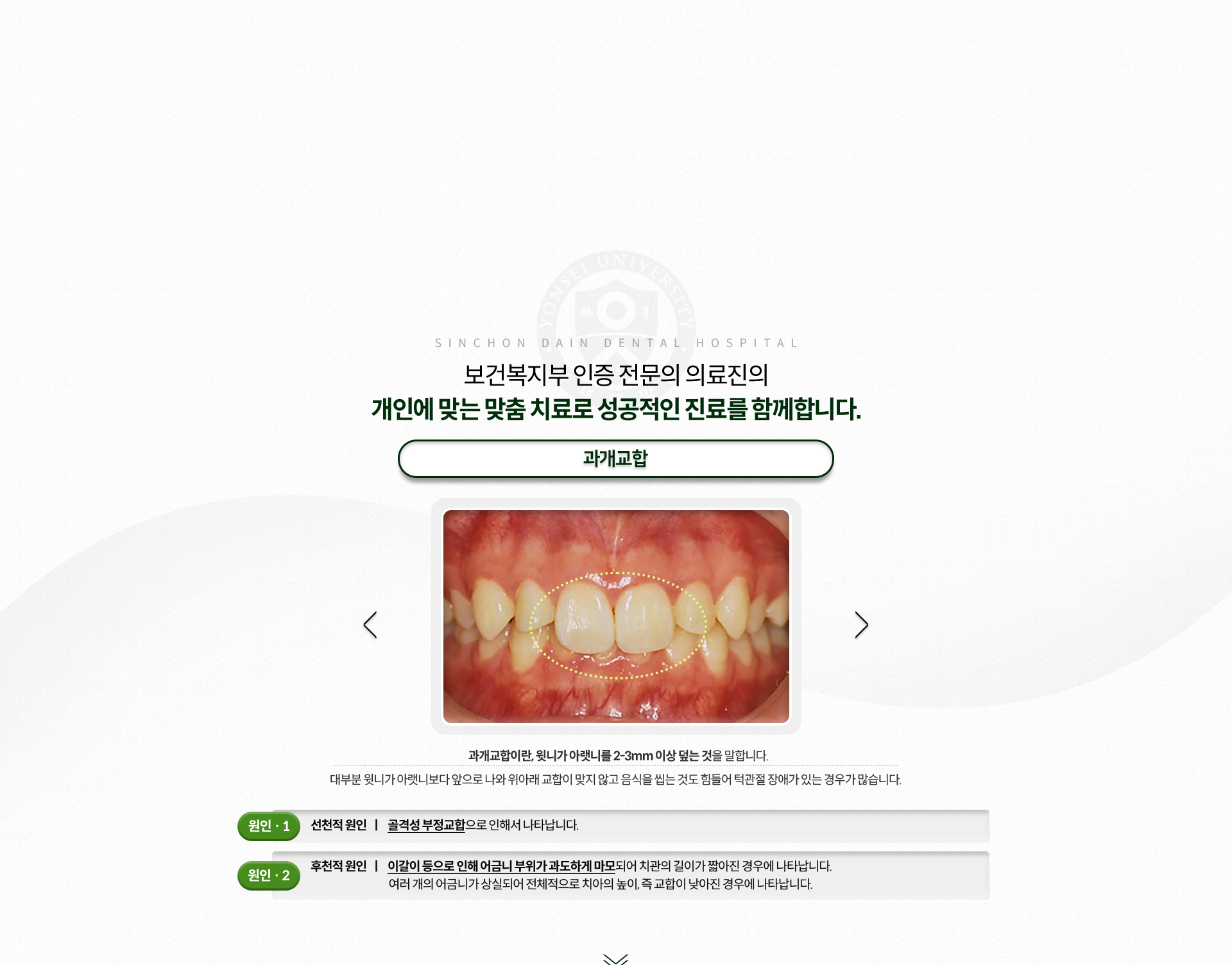 과개교합-윗니가-아랫니를-2~3mm이상-덮는-것-음식을-씹는-것도-힘들어-턱관절-장애가-있는-경우가-많음-원인1-선천적-원인-골격성-부정교합-원인2-후천적-원인-이갈이-등으로-인해-어금니-부위가-과도하게-마모되어-치관의-길이가-짧아진-경우,-여러-개의-어금니가-상실되어-전체적으로-치아의-높이,-즉-교합이-낮아진-경우