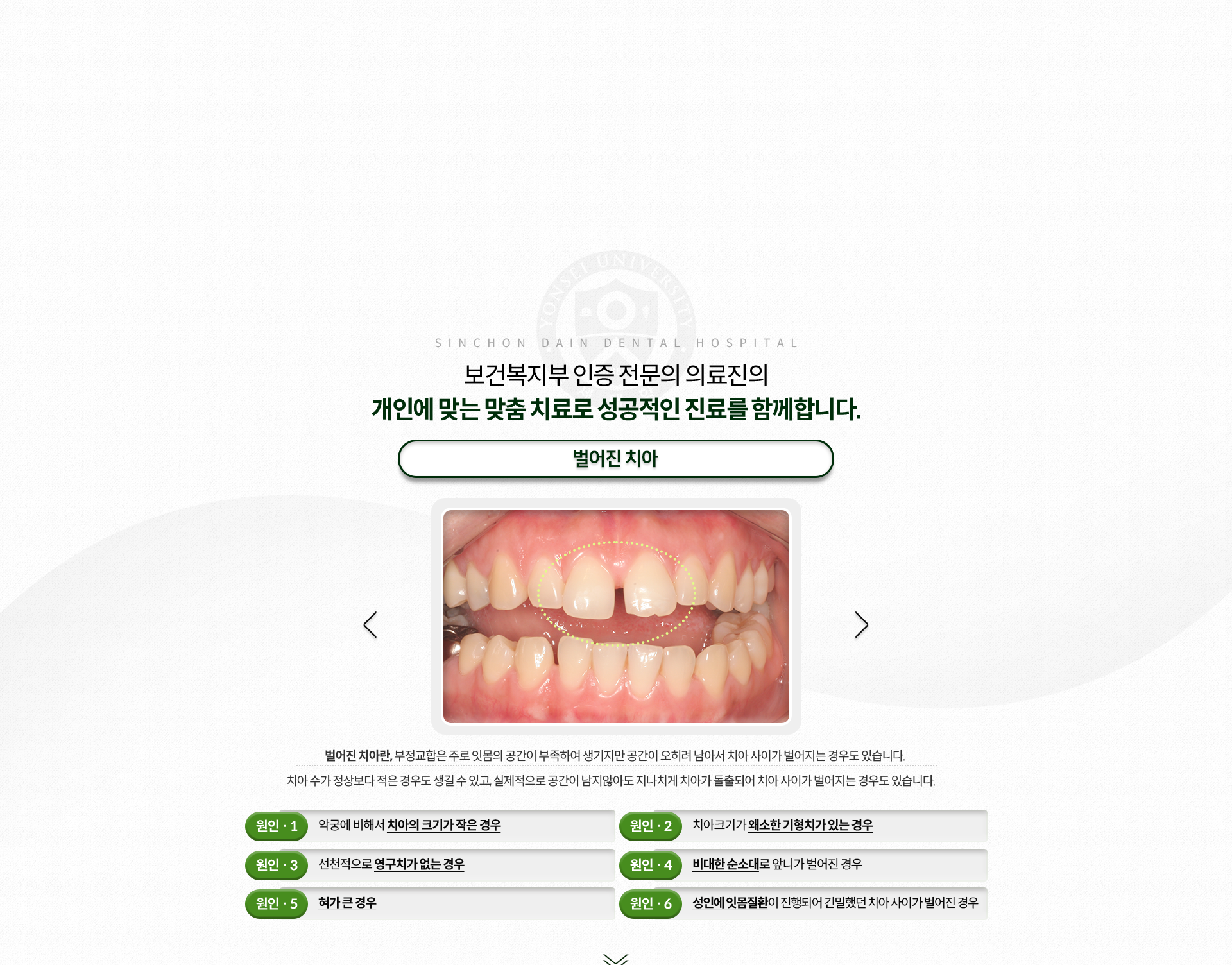 벌어진-치아-부정교합은-주로-잇몸의-공간이-부족하여-생기지만-공간이-오히려-남아서-치아-사이가-벌어지는-경우도-있음-치아-수가-정상보다-적은-경우도-생길-수-있고,-실제적으로-공간이-남지-않아도-치아가-지나치게-돌출되어-치아-사이가-벌어지는-경우도-있음-원인1-악궁에-비해-치아의-크기가-작은-경우-원인2-치아크기가-왜소한-기형치가-있는-경우-원인3-선천적으로-영구치가-없는-경우-원인4-비대한-순소대로-앞니가-벌어진-경우-원인5-혀가-큰-경우-원인6-성인에-잇몸질환이-진행되어-긴밀했던-치아-사이가-벌어진-경우