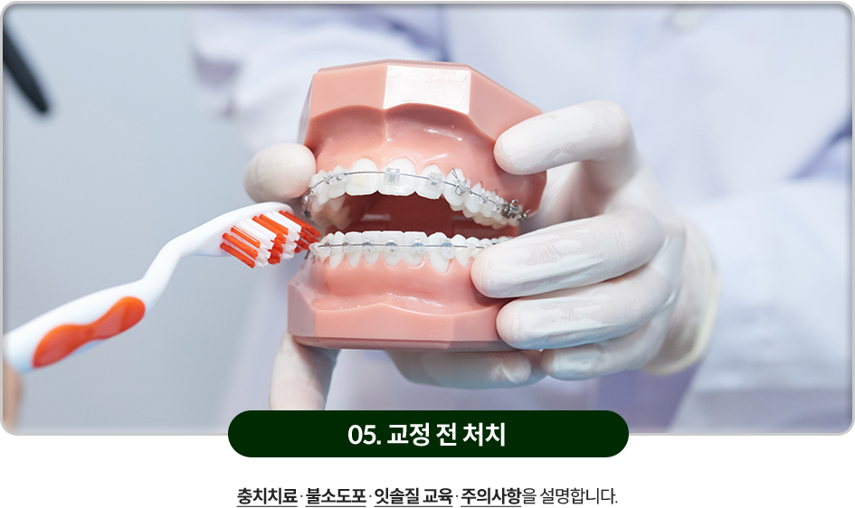 05)-교정-전-처치-충치치료와-불소도포,-잇솔질-교육,-주의사항을-설명합니다