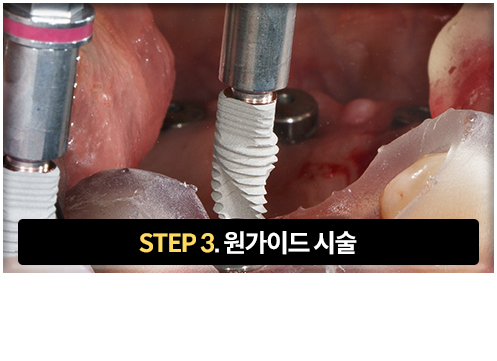 3단계-원가이드-시술-맞춤형-원가이드를-장착하여-계획된-위치에-임플란트-식립