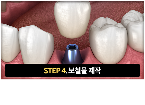 4단계-보철물-제작-인접치와-균형,-교합을-고려한-맞춤-보철물-제작-및-장착