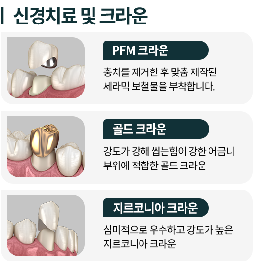 신경치료-및-크라운-종류1-PFM-크라운-충치를-제거한-후-맞춤-제작된-세라믹-보철물을-부착합니다-종류2-골드-크라운-강도가-강해-씹는힘이-강한-어금니-부위에-적합합니다-종류3-지르코니아-크라운-심미적으로-우수하고-강도가-높습니다