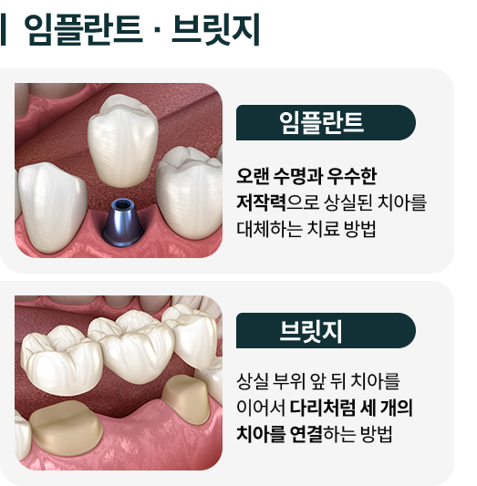 임플란트/브릿지-임플란트-오랜-수명과-우수한-저작력으로-상실된-치아를-대체하는-치료-방법-브릿지-상실-부위-앞-뒤-치아를-이어서-다리처럼-세-개의-치아를-연결하는-방법