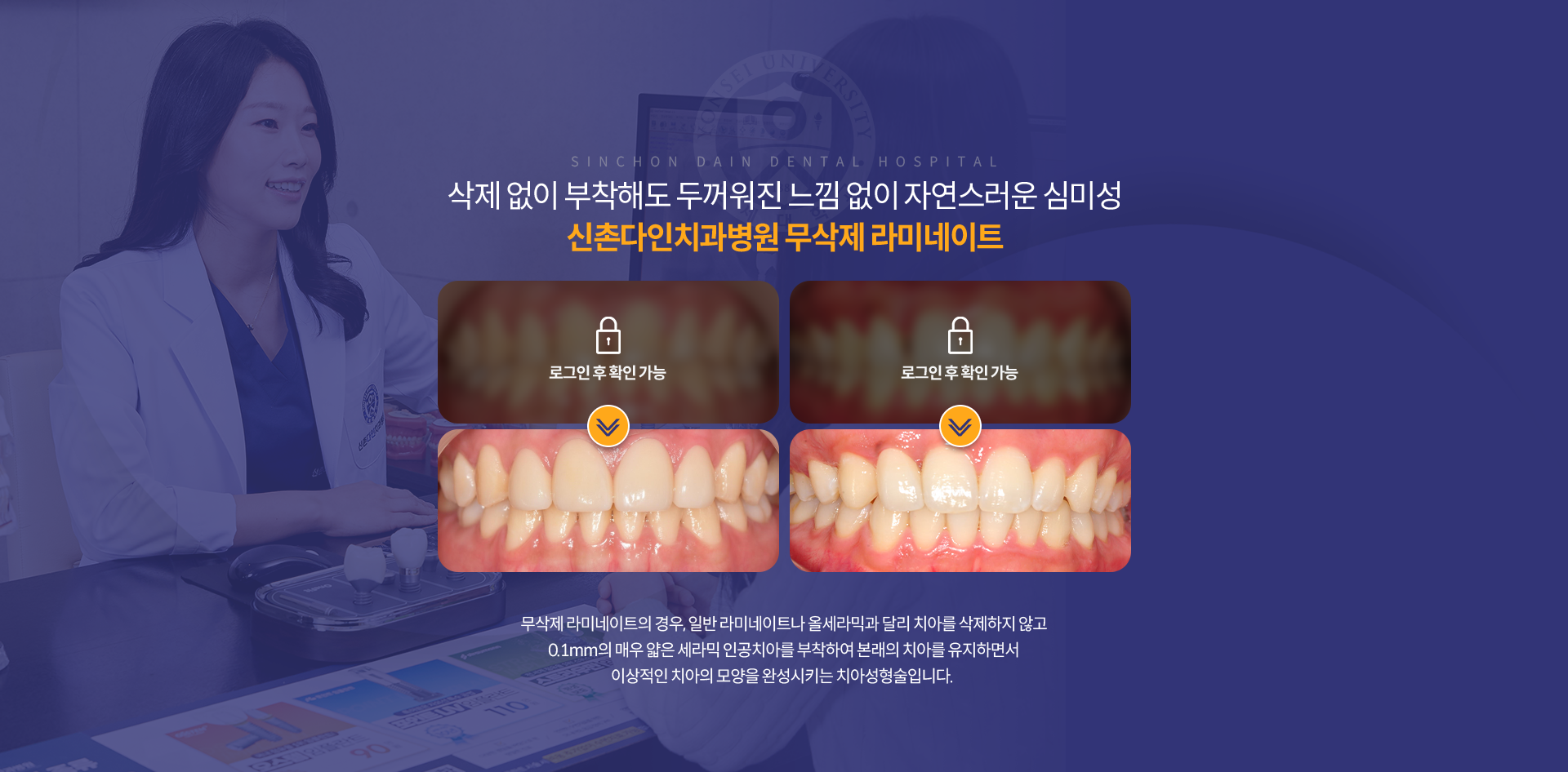 삭제-없이-부착해도-두꺼워진-느낌-없이-자연스러운-심미성-무삭제-라미네이트-무삭제-라미네이트의-경우,-일반-라미네이트나-올세라믹과-달리-치아를-삭제하지-않고-0.1mm의-매우-얇은-세라믹-인공치아를-부착하여-본래의-치아를-유지하면서-이상적인-치아의-모양을-완성시키는-치아성형술입니다