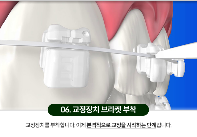 06)-교정장치-브라켓-부착-교정장치를-부착합니다-이제-본격적으로-교정을-시작하는-단계입니다