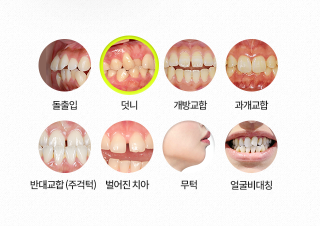 덧니