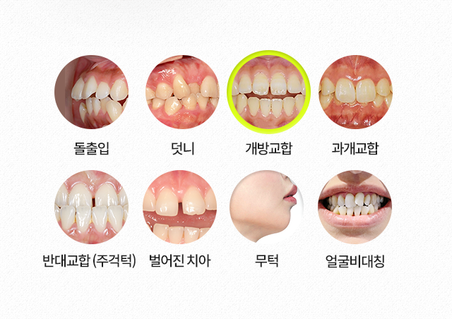 개방교합