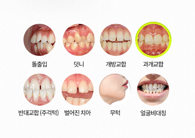과개교합