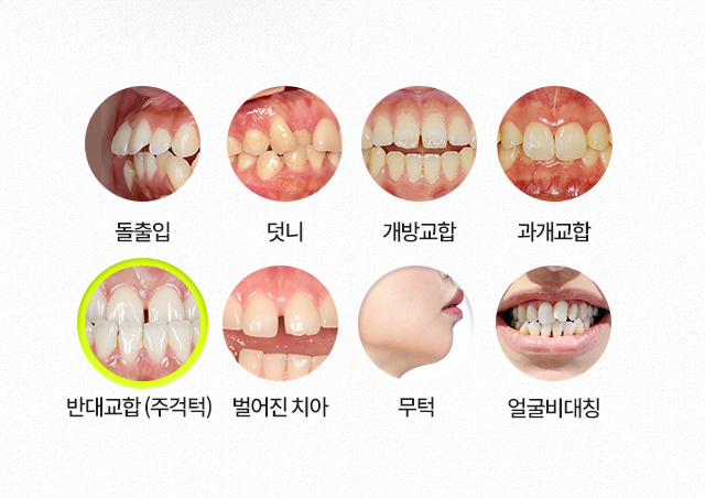 반대교합(주걱턱)