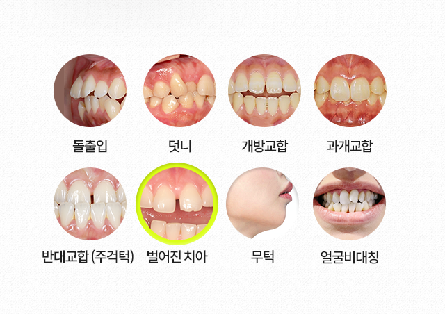 벌어진치아