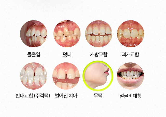무턱