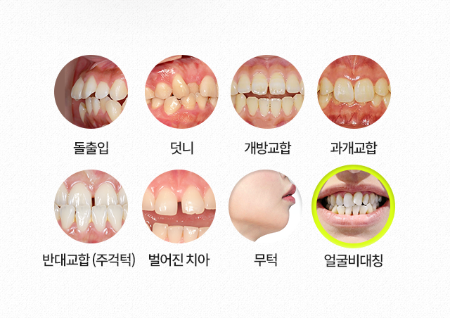 얼굴비대칭