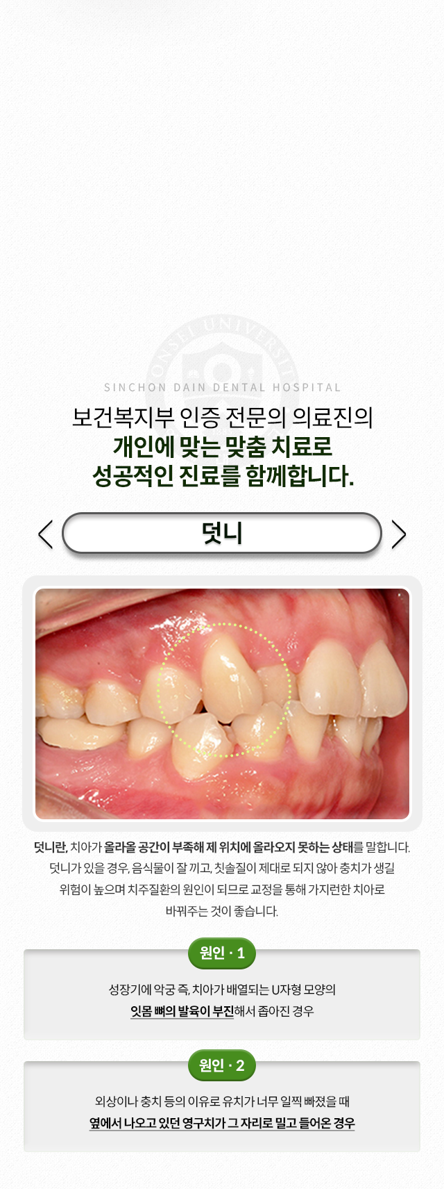 덧니-치아가-올라올-공간이-부족해-제-위치에-올라오지-못하는-상태-음식물이-잘-끼고-칫솔질이-제대로-되지-않아-충치가-생길-위험이-높으며,-치주질환의-원인이-됨-원인1-성장기에-치아가-배열되는-U자형-모양의-잇몸-뼈의-발육이-부진해서-좁아진-경우-원인2-외상이나-충치-등의-이유로-유치가-너무-일찍-빠졌을-때-옆에서-나오고-있던-영구치가-그-자리로-밀고-들어온-경우