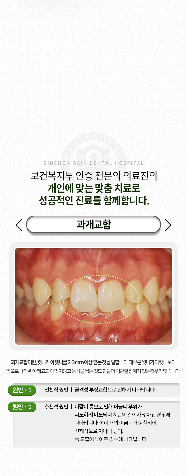과개교합-윗니가-아랫니를-2~3mm이상-덮는-것-음식을-씹는-것도-힘들어-턱관절-장애가-있는-경우가-많음-원인1-선천적-원인-골격성-부정교합-원인2-후천적-원인-이갈이-등으로-인해-어금니-부위가-과도하게-마모되어-치관의-길이가-짧아진-경우,-여러-개의-어금니가-상실되어-전체적으로-치아의-높이,-즉-교합이-낮아진-경우