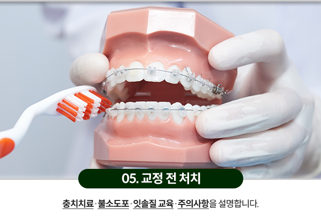 05)-교정-전-처치-충치치료와-불소도포,-잇솔질-교육,-주의사항을-설명합니다
