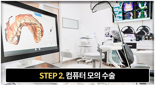2단계-컴퓨터-모의-수술-컴퓨터-모의-수술을-통해-적합한-수술-계획-수립