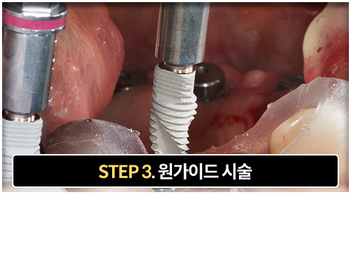 3단계-원가이드-시술-맞춤형-원가이드를-장착하여-계획된-위치에-임플란트-식립