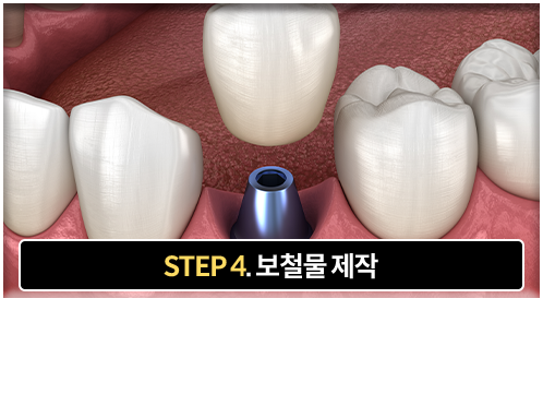 4단계-보철물-제작-인접치와-균형,-교합을-고려한-맞춤-보철물-제작-및-장착