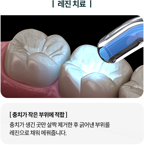 레진치료-충치가-작은-부위에-적합-충치가-생긴-곳만-살짝-제거한-후-긁어낸-부위를-레진으로-채워-메꿔줍니다