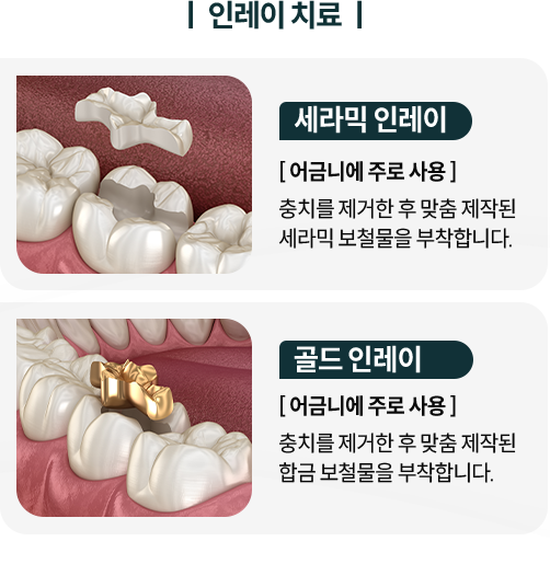 인레이-치료-종류1-세라믹-인레이-어금니에-주로-사용-충치를-제거한-후-맞춤-제작된-세라믹-보철물을-부착합니다-종류2-골드-인레이-어금니에-주로-사용-충치를-제거한-후-맞춤-제작된-합금-보철물을-부착합니다