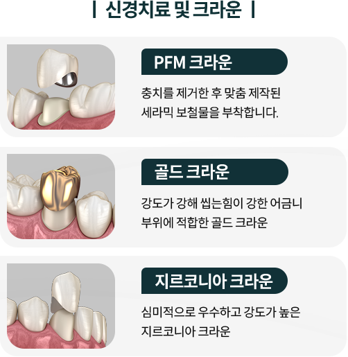 신경치료-및-크라운-종류1-PFM-크라운-충치를-제거한-후-맞춤-제작된-세라믹-보철물을-부착합니다-종류2-골드-크라운-강도가-강해-씹는힘이-강한-어금니-부위에-적합합니다-종류3-지르코니아-크라운-심미적으로-우수하고-강도가-높습니다