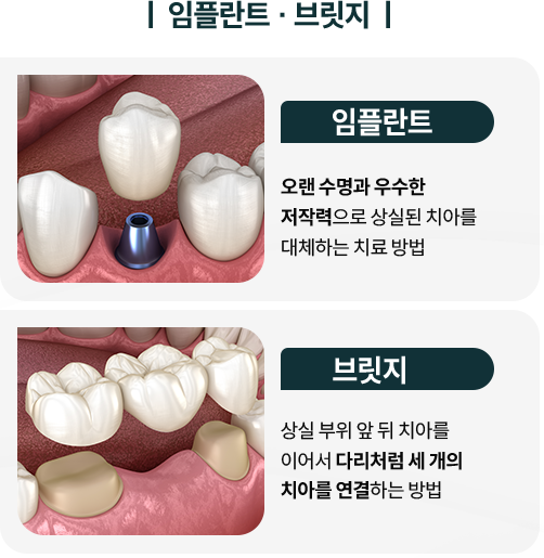 임플란트/브릿지-임플란트-오랜-수명과-우수한-저작력으로-상실된-치아를-대체하는-치료-방법-브릿지-상실-부위-앞-뒤-치아를-이어서-다리처럼-세-개의-치아를-연결하는-방법