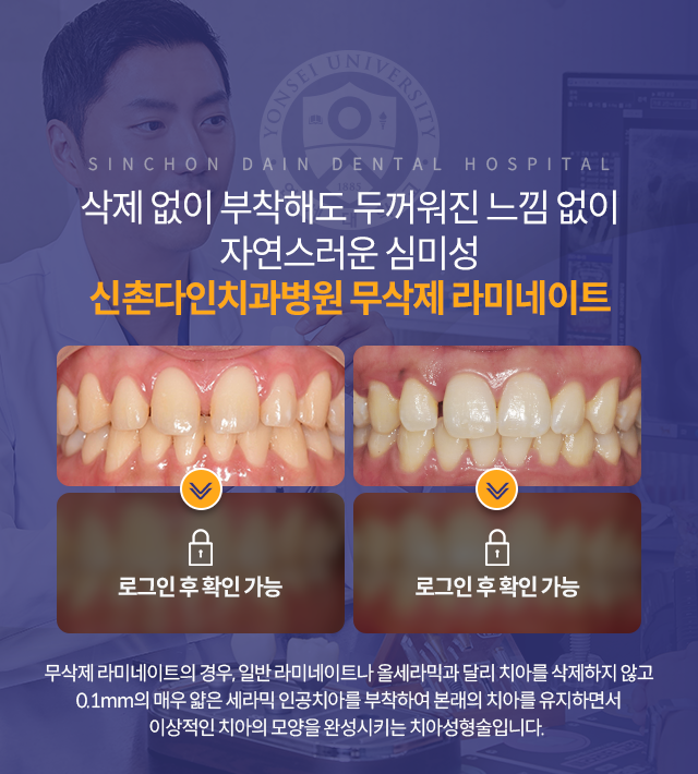 무삭제-라미네이트의-경우,-일반-라미네이트나-올세라믹과-달리-치아를-삭제하지-않고-0.1mm의-매우-얇은-세라믹-인공치아를-부착하여-본래의-치아를-유지하면서-이상적인-치아의-모양을-완성시키는-치아성형술입니다