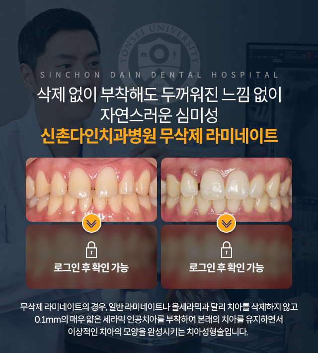 무삭제-라미네이트의-경우,-일반-라미네이트나-올세라믹과-달리-치아를-삭제하지-않고-0.1mm의-매우-얇은-세라믹-인공치아를-부착하여-본래의-치아를-유지하면서-이상적인-치아의-모양을-완성시키는-치아성형술입니다