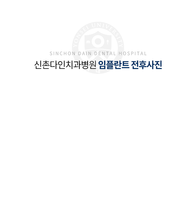 임플란트-전후사진