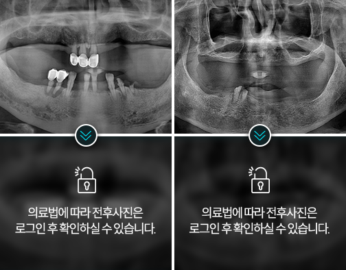 임플란트-전후사진1