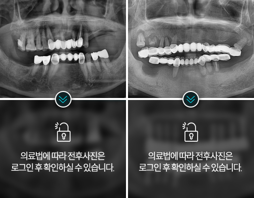 임플란트-전후사진2