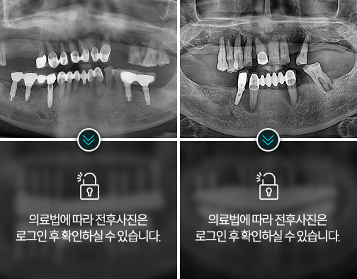 임플란트-전후사진3