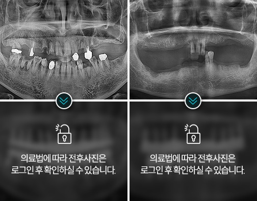 임플란트-전후사진4