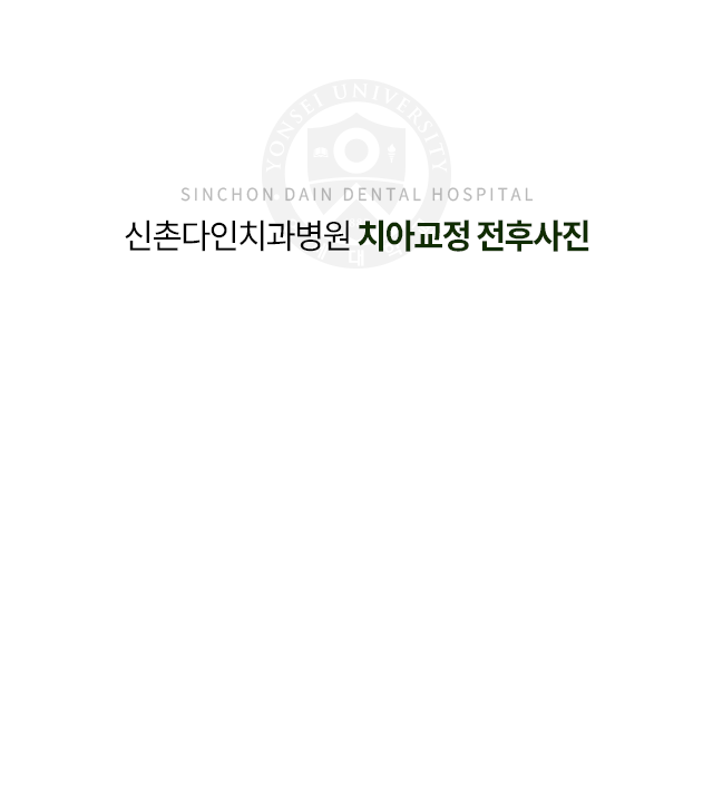 치아교정-전후사진