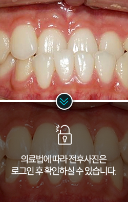 치아교정-전후사진1