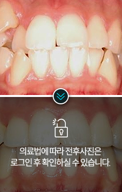 치아교정-전후사진2
