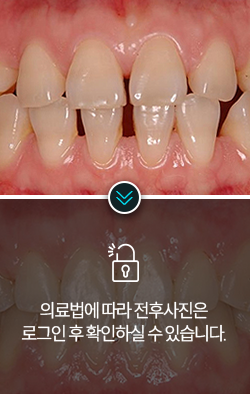 치아교정-전후사진3