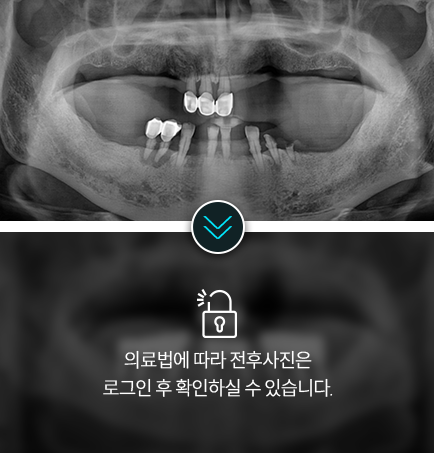 임플란트-전후사진1