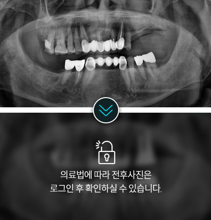 임플란트-전후사진3