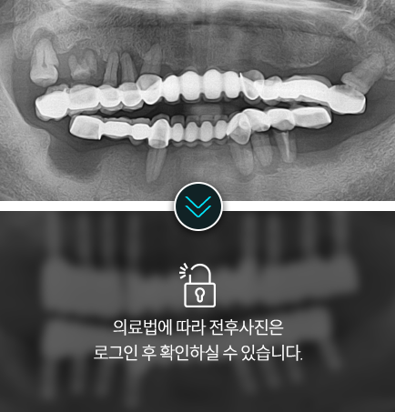 임플란트-전후사진4