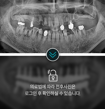 임플란트-전후사진7