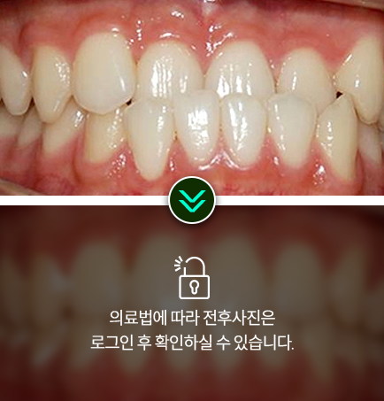 치아교정-전후사진1