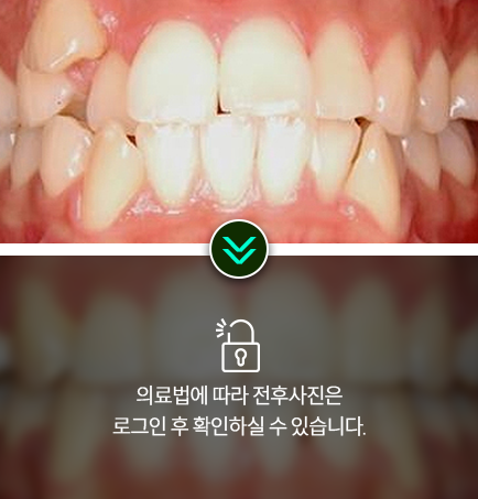 치아교정-전후사진2