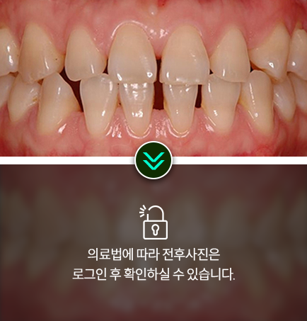 치아교정-전후사진3