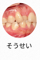 덧니